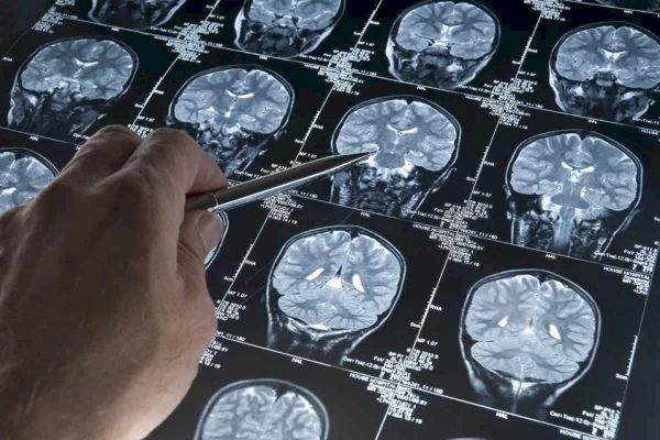 Paciente de 19 anos é diagnosticado com Alzheimer na China