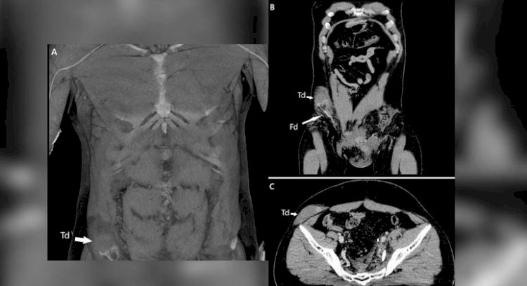 Em caso raro na medicina, testículo é deslocado para dentro do abdômen após acidente de moto