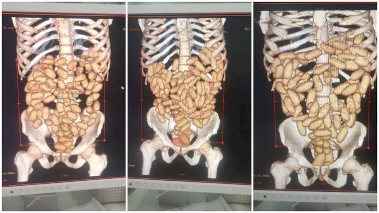 Em 5 anos, PF prende mais de 40 passageiros ao tentarem embarcar com cápsulas de cocaína no aeroporto de Guarulhos